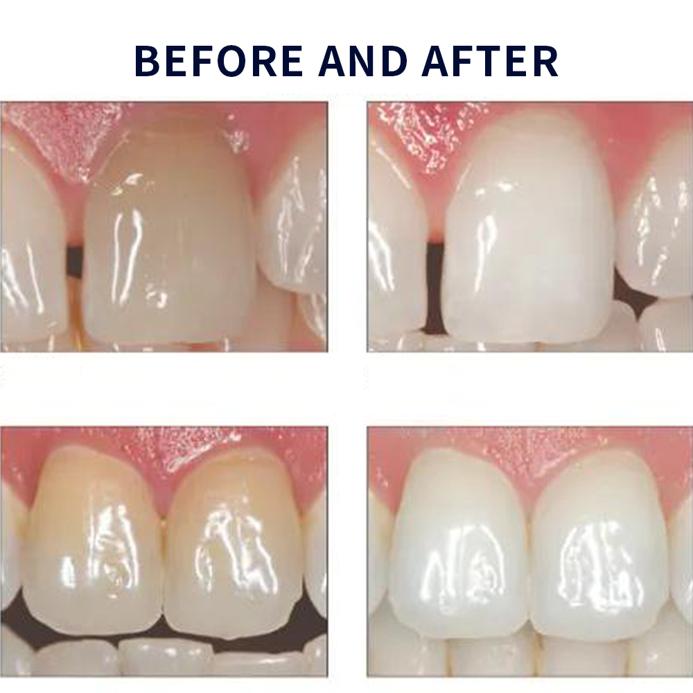 Отбеливающий набор opalution 2 – обзор и цена Teeth Whitening Gel Peroxide