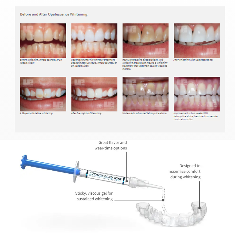 Отбеливающий набор opalution 2 – обзор и цена Teeth Whitening Gel Peroxide