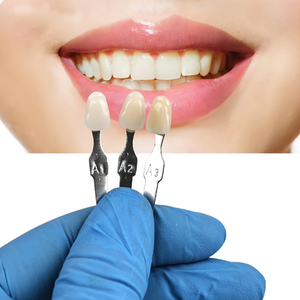 Набор для отбеливания и полиро – обзор и цена Teeth Whitening Shade Guide