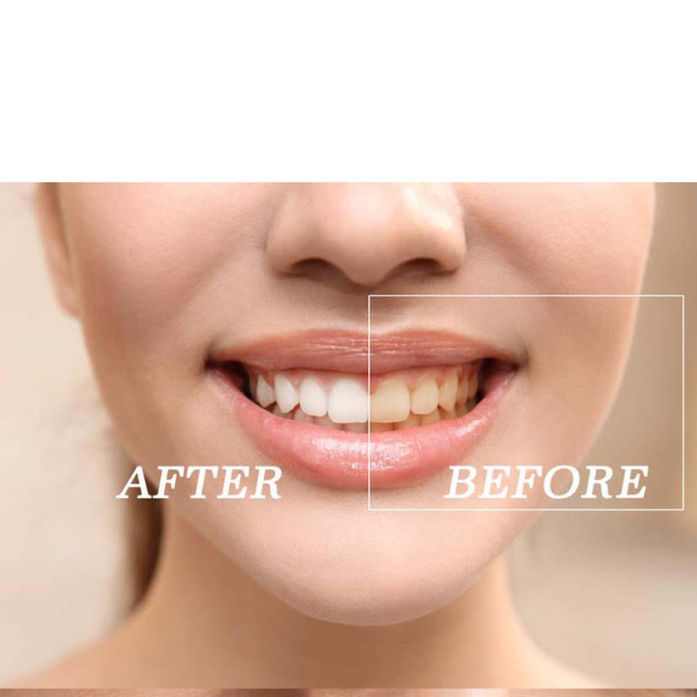 Высокое качество пероксид отбе – обзор и цена Teeth Whitening Gel Peroxide